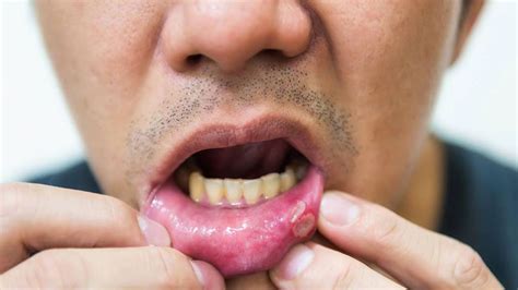 ağız yarası nasıl geçer karbonat